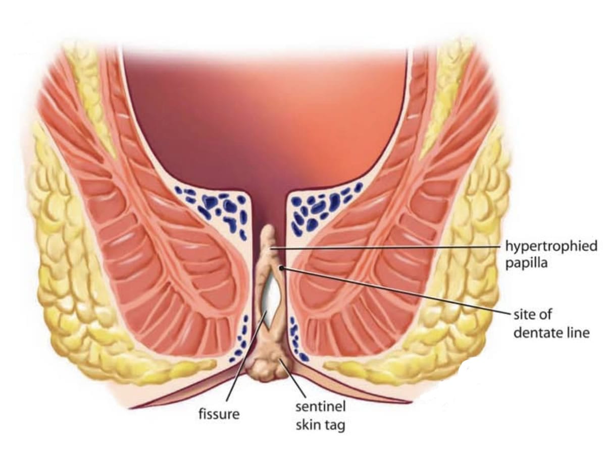 درمان خانگی شقاق مقعدی