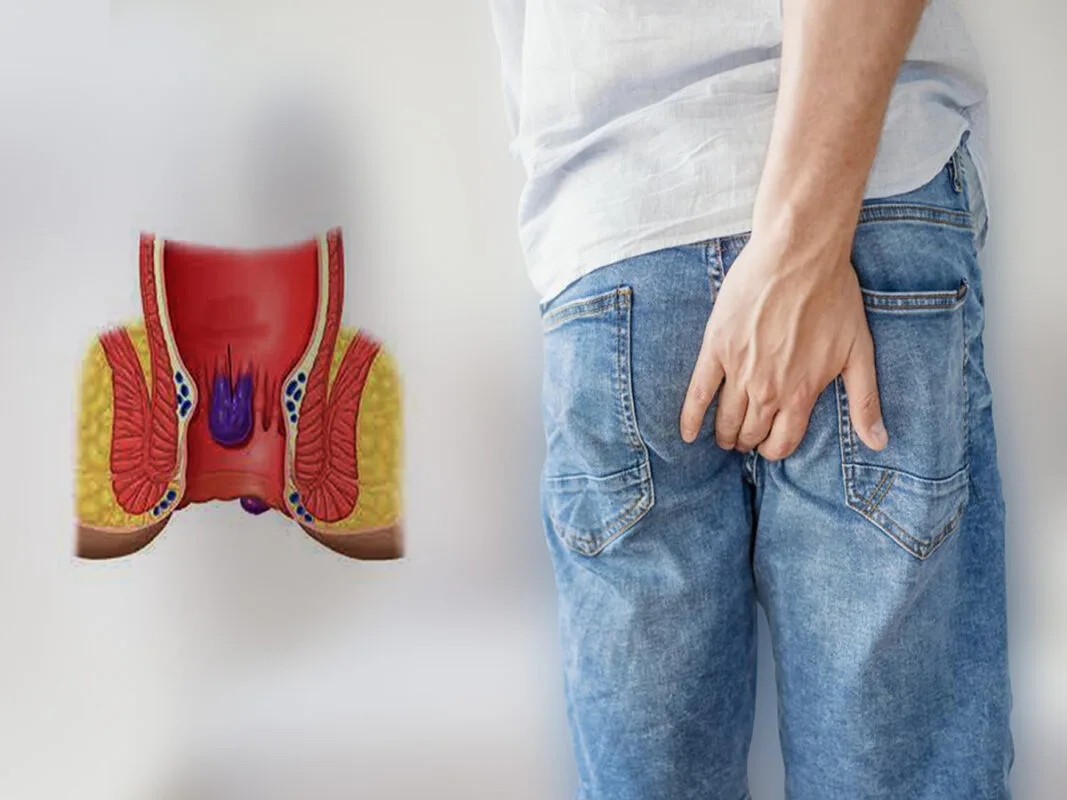 هزینه جراحی هموروئید با لیزر در ورامین