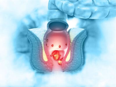 کلینیک لیزر هموروئید در اکباتان