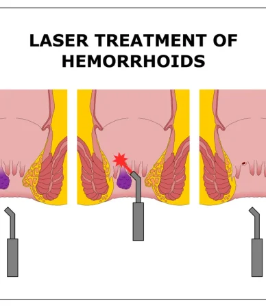 درمان قطعی بواسیر با لیزر؛ تجربهای ایمن و مؤثر