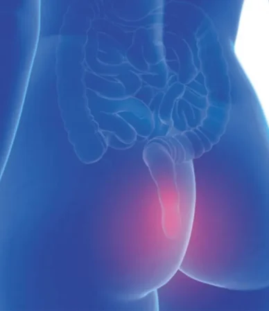 بواسیر یا هموروئید؛ شایع‌ترین بیماری مقعدی