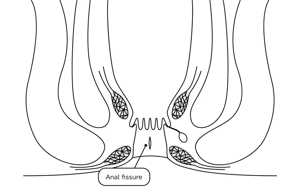پیشگیری از عود شقاق یا فیشر مقعد