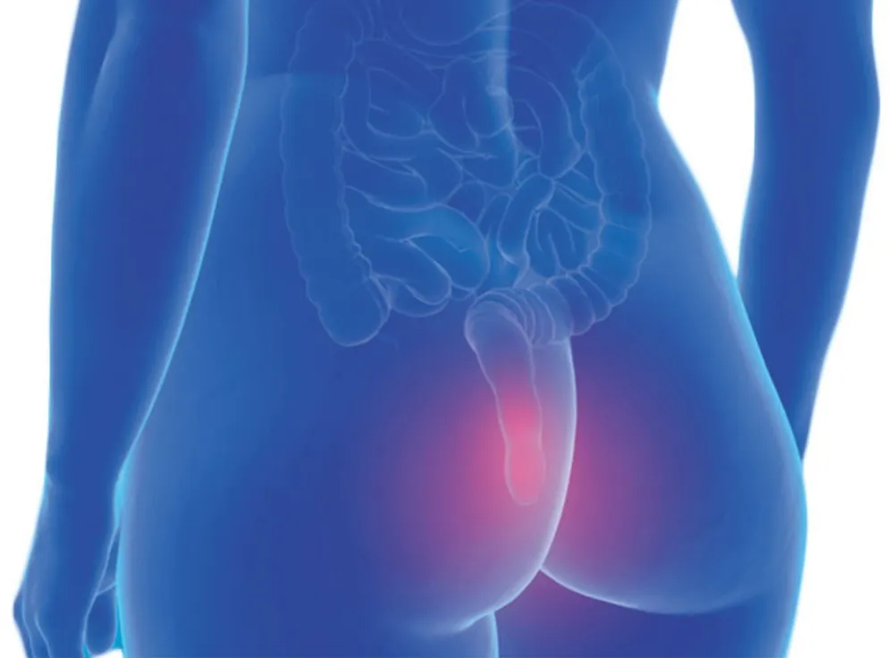 بواسیر یا هموروئید؛ شایعترین بیماری مقعدی