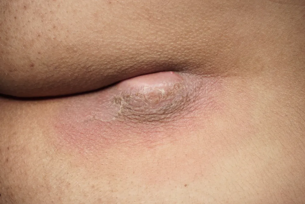 درمان قطعی کیست مویی بدون نیاز به جراحی