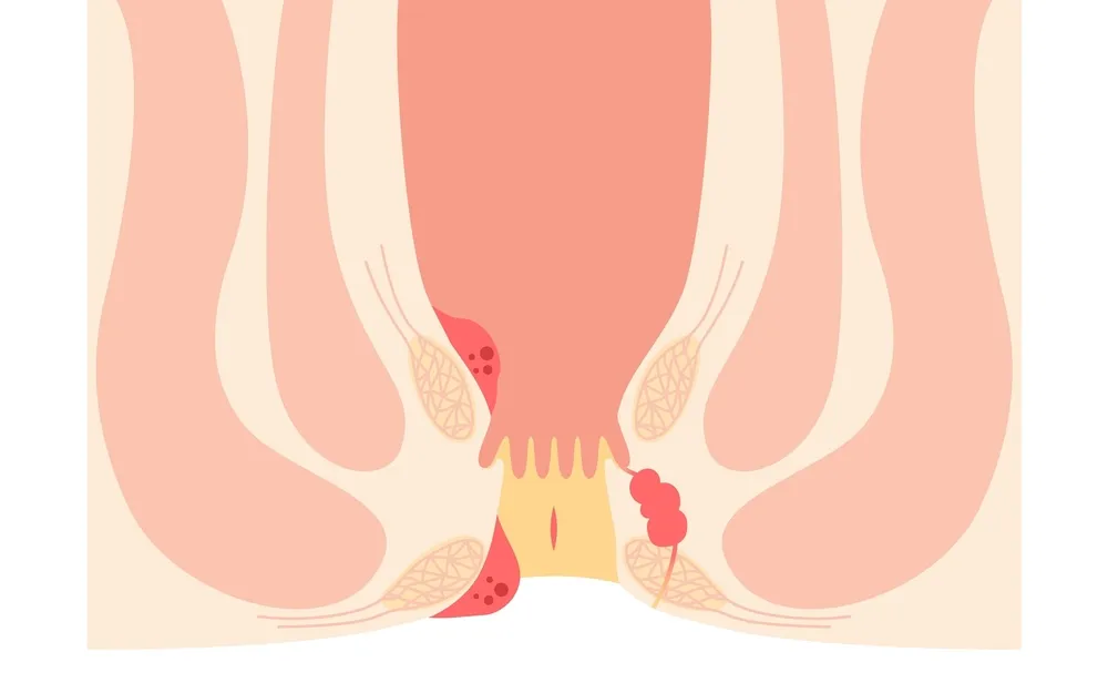 حمام سیتز و درمان بواسیر