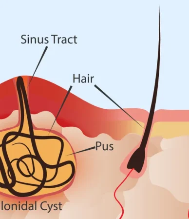 کیست مویی: راهنمای جامع شناخت و عوامل ایجادکننده