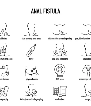 فیستول مقعدی: از دلایل تا درمان راهنمای جامع