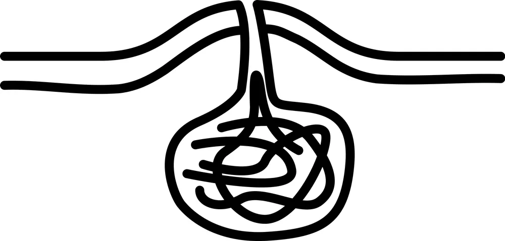 معایب و محدودیت‌های درمان لیزری کیست مویی