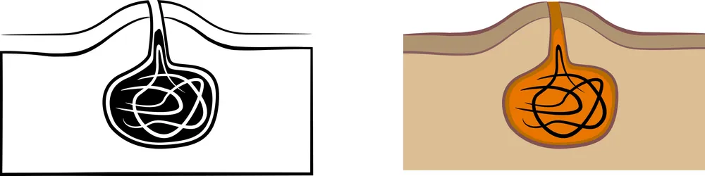 روند درمان کیست مویی با لیزر