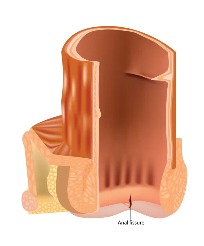 لیزر شقاق مقعدی؛ انتخابی پیشرفته و کمدرد