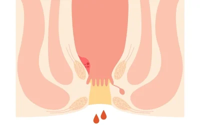 خونریزی به دنبال دفع مدفوع