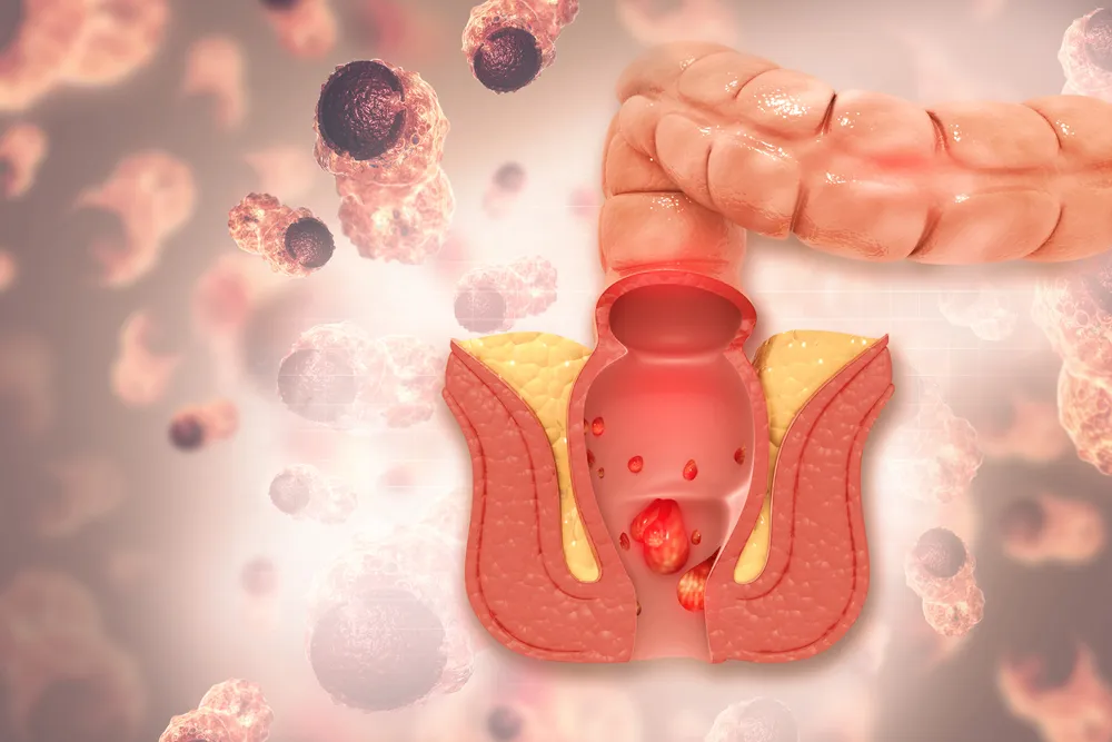 روشهای درمان قطعی بواسیر داخلی تحت نظر پزشک