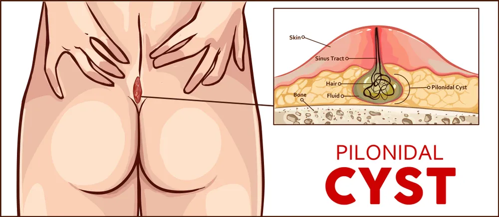 کیست مویی؛ بررسی علائم و عوارض سینوس پیلونیدال در ناحیه پایین کمر