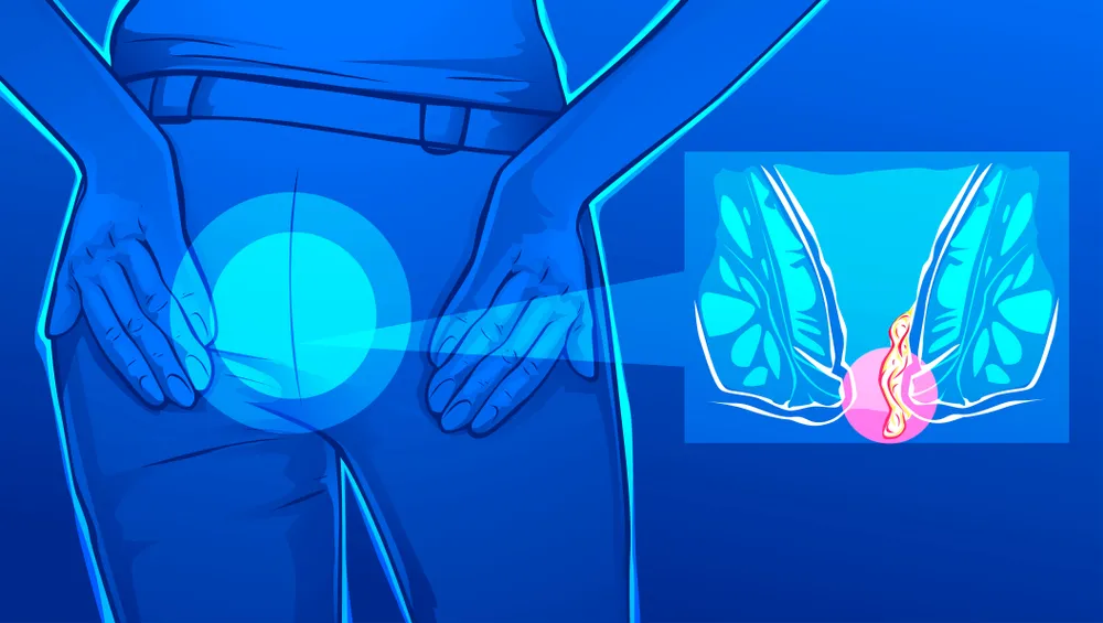 آبسه مقعدی:از دلایل، عوامل تا تشخیص و درمان