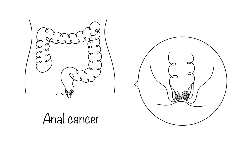 سرطان مقعد: شناخت کامل علائم و نشانه‌های هشداردهنده