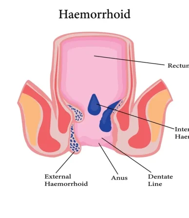 بواسیر داخلی: از نشانههای ظاهری و بالینی تا درمان