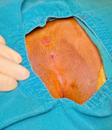 جراحی کیست مویی به روش باز: از مراحل تا درمان کامل