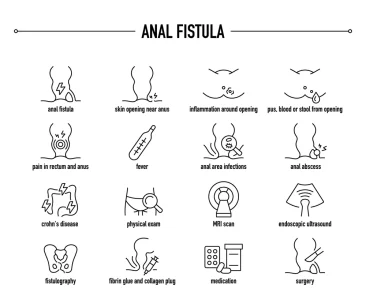 عمل فیستول: از تکنیک ها تا مراقبت های بعد از عمل