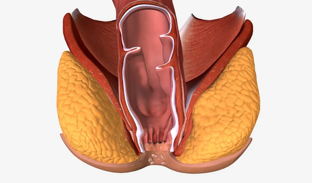 زگیل مقعدی؛ دلایل بروز، روش‌های انتقال و درمان پزشکی