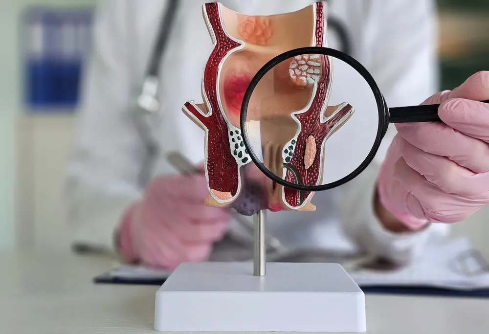 بررسی کامل جراحی بواسیر داخلی