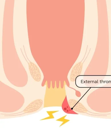 بواسیر خارجی: از علل و علائم تا درمان