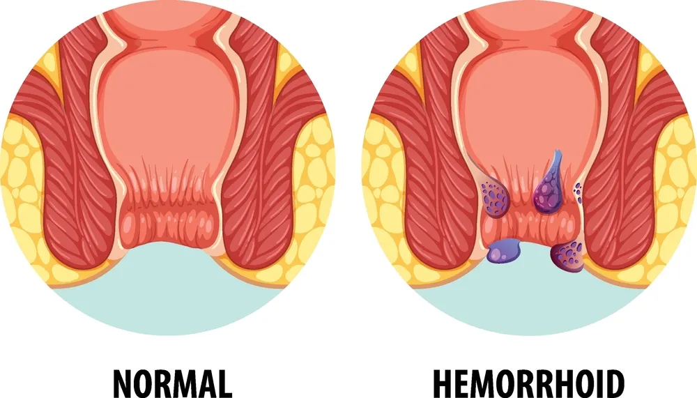 معرفی کامل بیماری بواسیر یا هموروئید با علائم و درمان‌های مؤثر