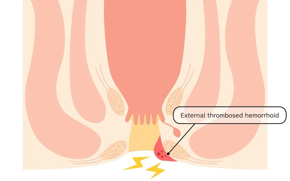 هموروئید ترومبوزه؛ علل و درمان