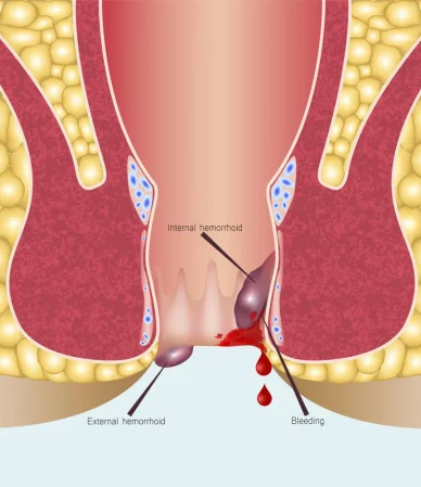 بواسیر یا هموروئید خونی: از مهمترین علائم خطر تا درمان و دارو