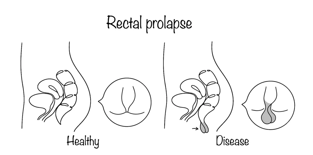 دلایل اصلی پرولاپس رکتوم