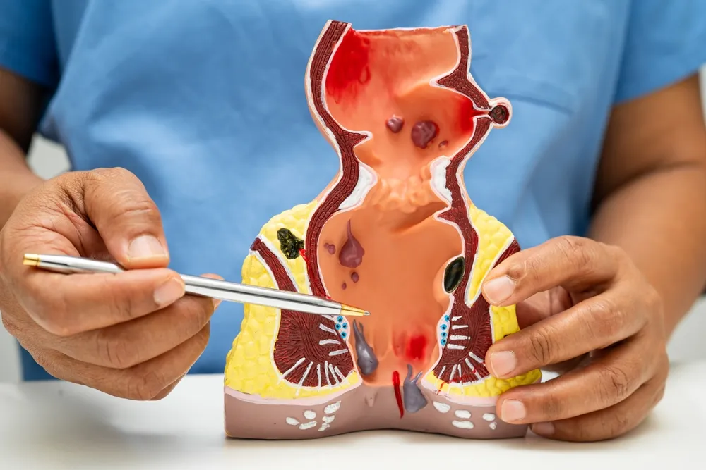 بواسیر یا هموروئید و راهکارهای پیشگیری و درمان آن