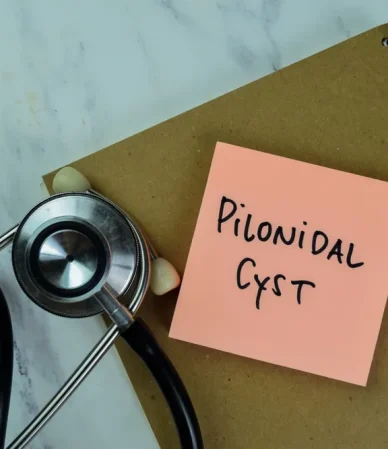 درمان خانگی کیست مویی بدون نیاز به جراحی