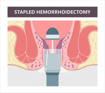 کاربرد جراحی هموروئیدکتومی در انواع بواسیر