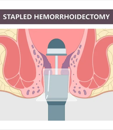 کاربرد جراحی هموروئیدکتومی در انواع بواسیر