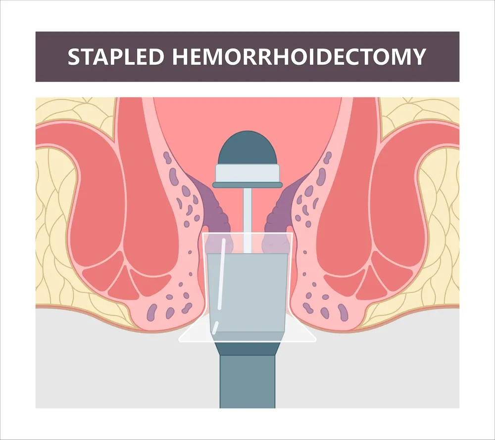 کاربرد جراحی هموروئیدکتومی در انواع بواسیر
