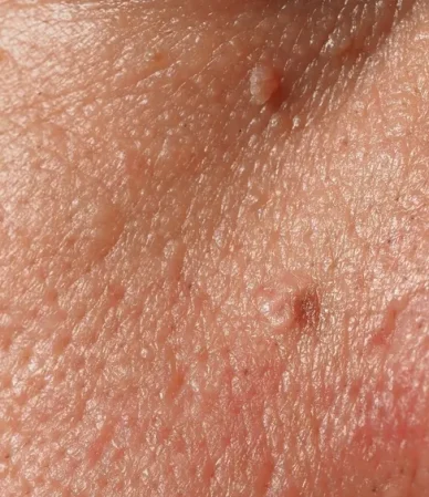 گوشت اضافه مقعدی: از پیشگیری تا درمان موثر