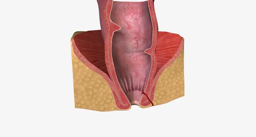 شقاق مقعد و ایجاد زخم‌های دردناک