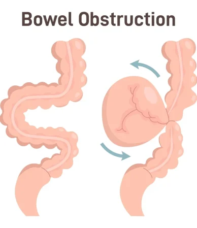 انسداد روده: دلایل، علائم و راه‌های درمان