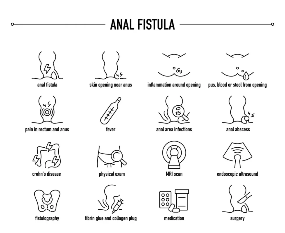 فیستول مقعدی و مسیر غیرطبیعی بین روده و پوست