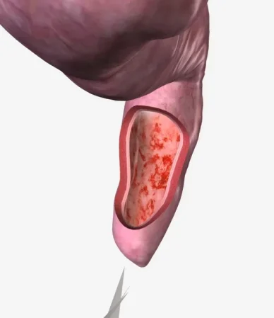 التهاب و ورم مقعدی: از تشخیص تا درمان
