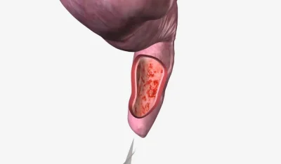 التهاب و ورم مقعدی: از تشخیص تا درمان