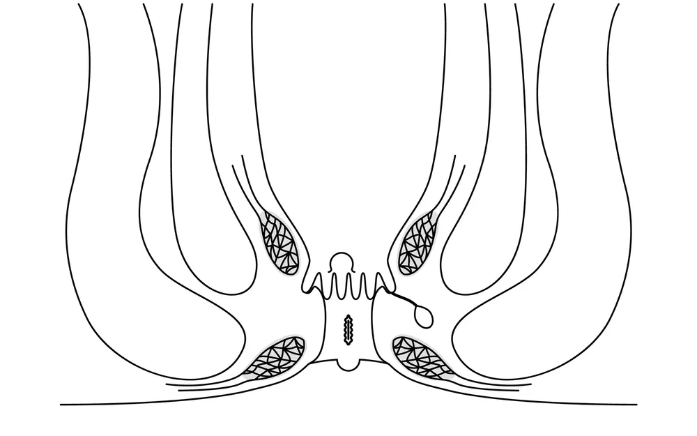 راهکارهای درمان تنگی مقعد با طب سنتی