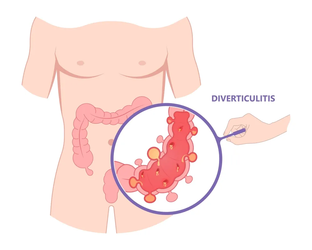 دیورتیکولیت و نقش آن در بروز فیستول