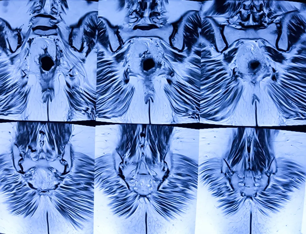 مراقبت‌ها و نکات پس از درمان تنگی مقعد