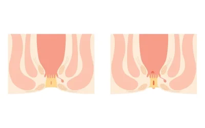 تنگی مقعد: از عوارض تا درمان