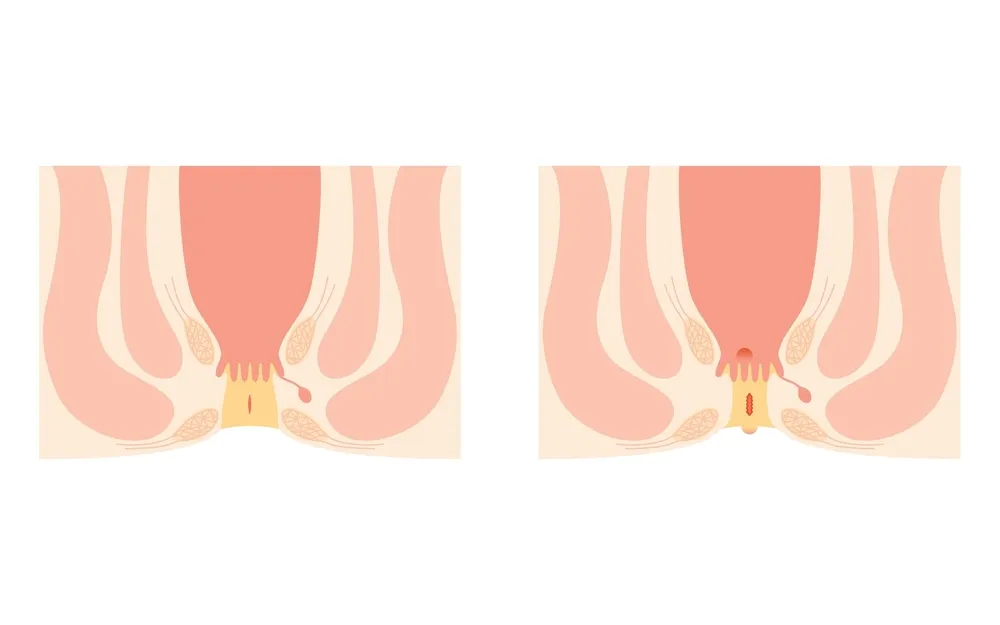 تنگی مقعد: از عوارض تا درمان