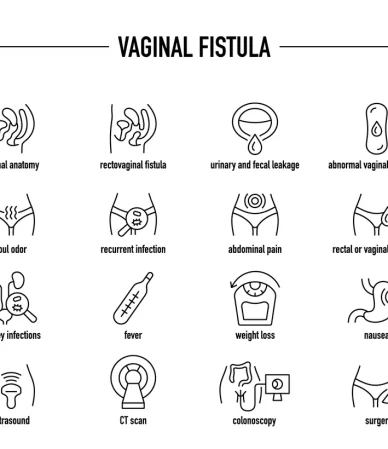 فیستول واژن: از علل و علایم تا درمان